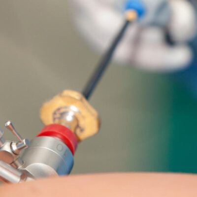 Videolaparoscopia: cirurgia minimamente invasivaVideolaparoscopia: cirurgia minimamente invasiva